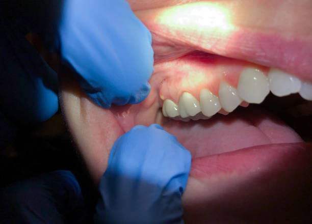 Best Emergency Dental Care for Abscessed Tooth in Charlevoix, MI